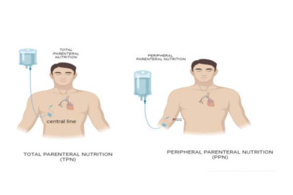 TPN vs PPN